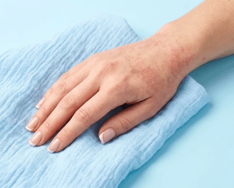 Atopični dermatitis na roki