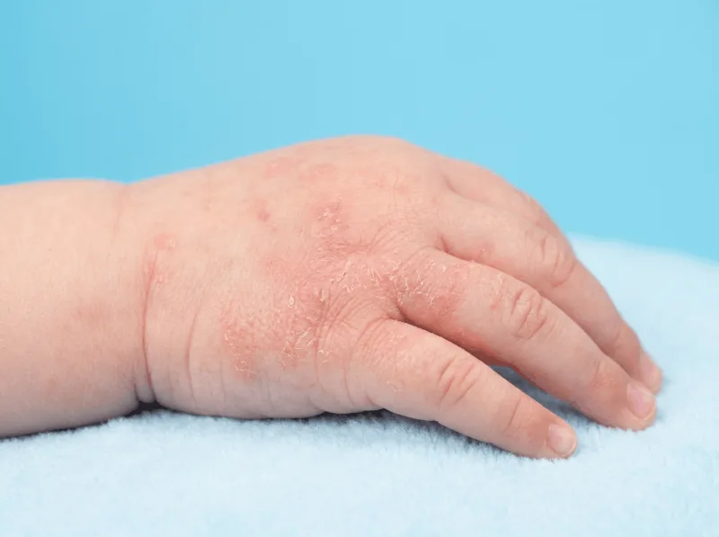 Atopični dermatitis na roki dojenčka
