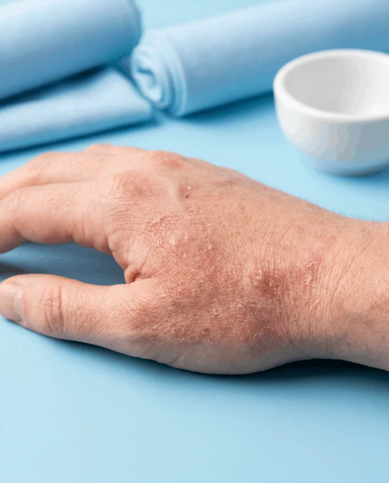 Atopični dermatitis na roki odrasle osebe — suha, razpokana koža