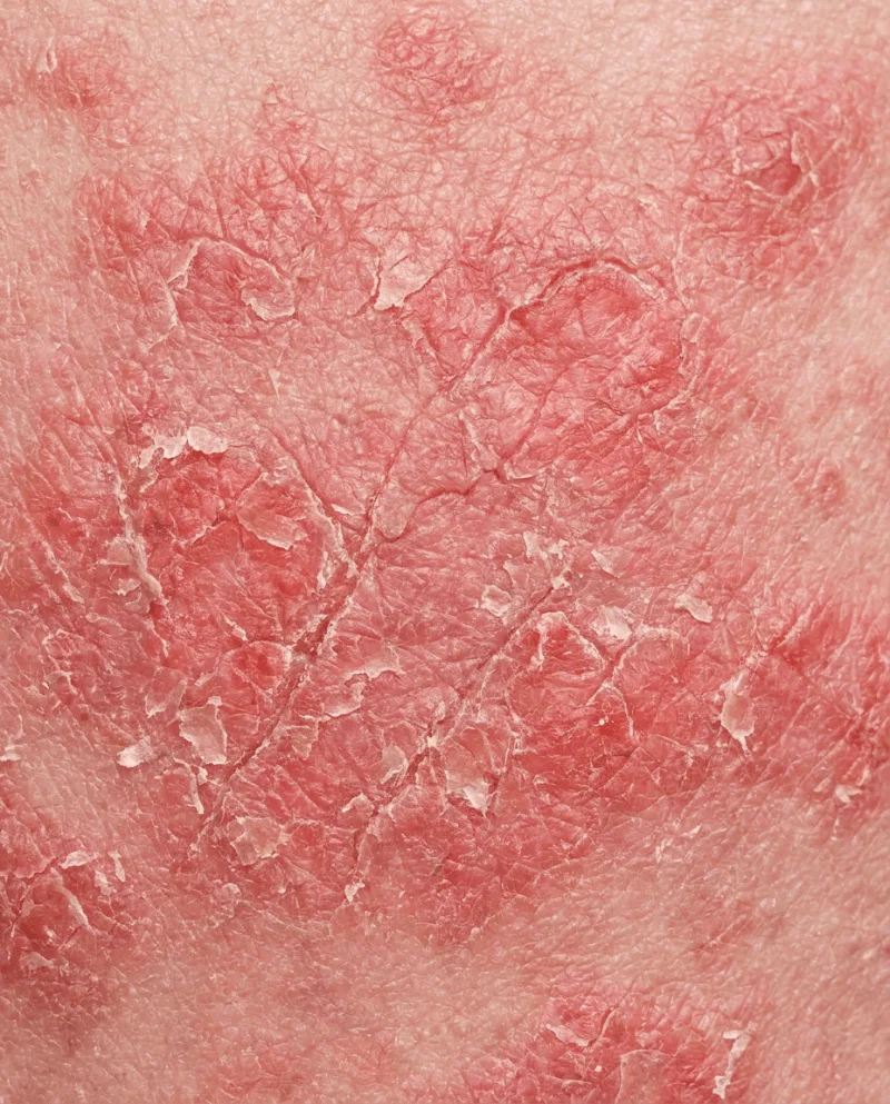 Atopični dermatitis — vnetje in luščenje kože od blizu